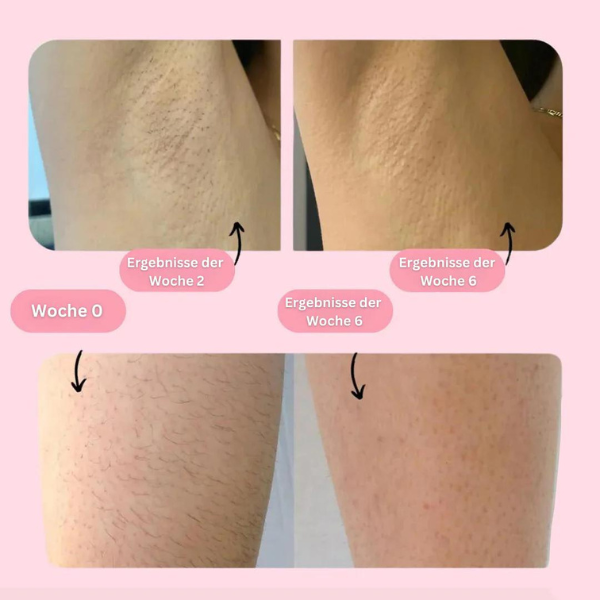 GlowSmooth Pro| Permanente Haarentfernung in nur 4 Wochen