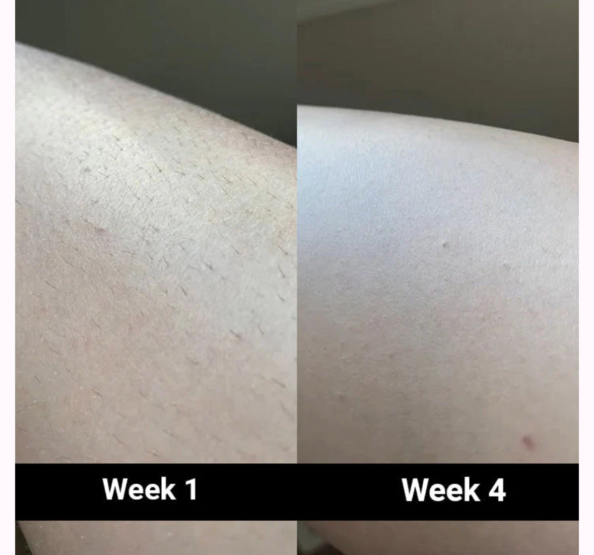 GlowSmooth Pro| Permanente Haarentfernung in nur 4 Wochen